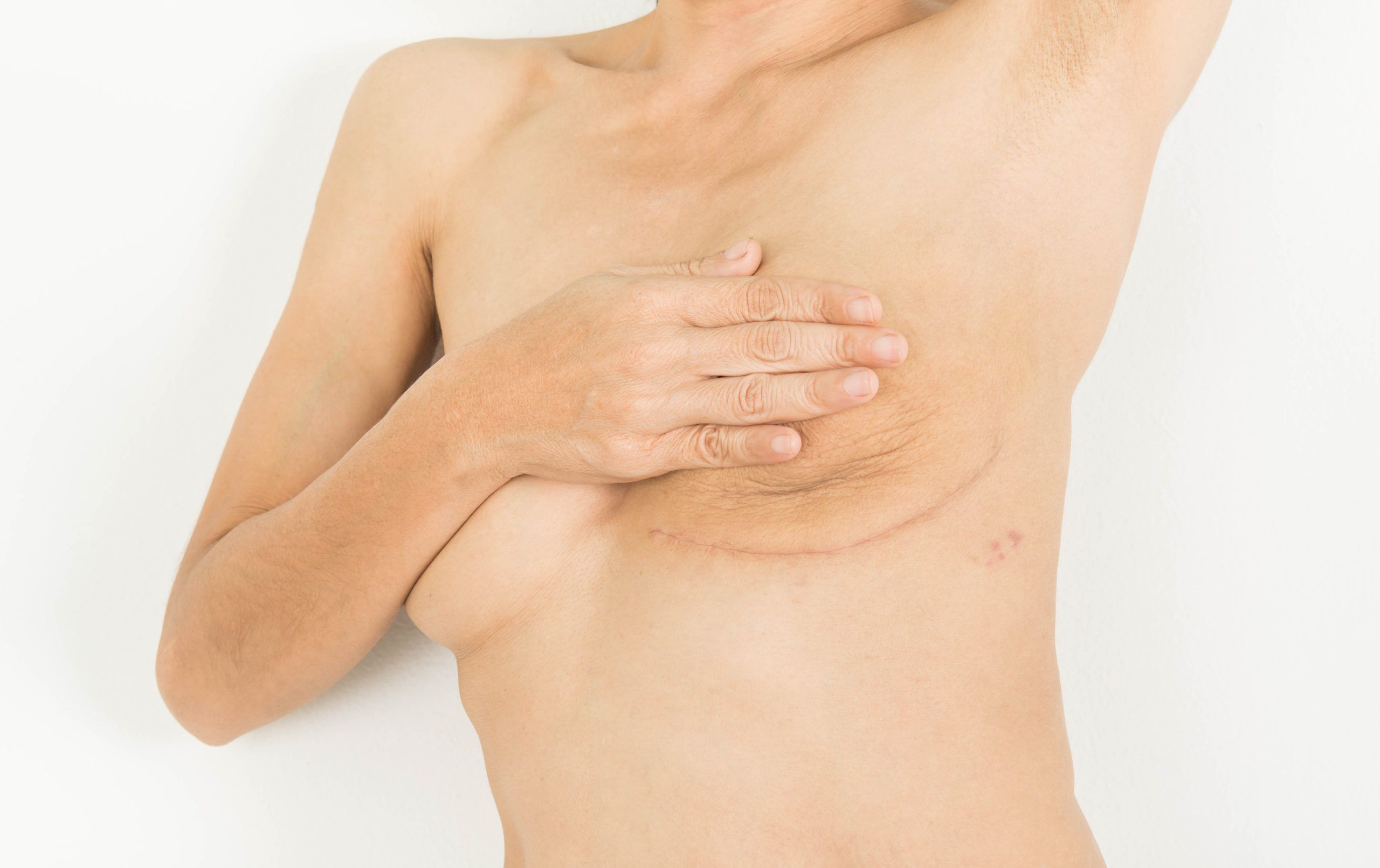 Breast Cancer Surgery in woman
