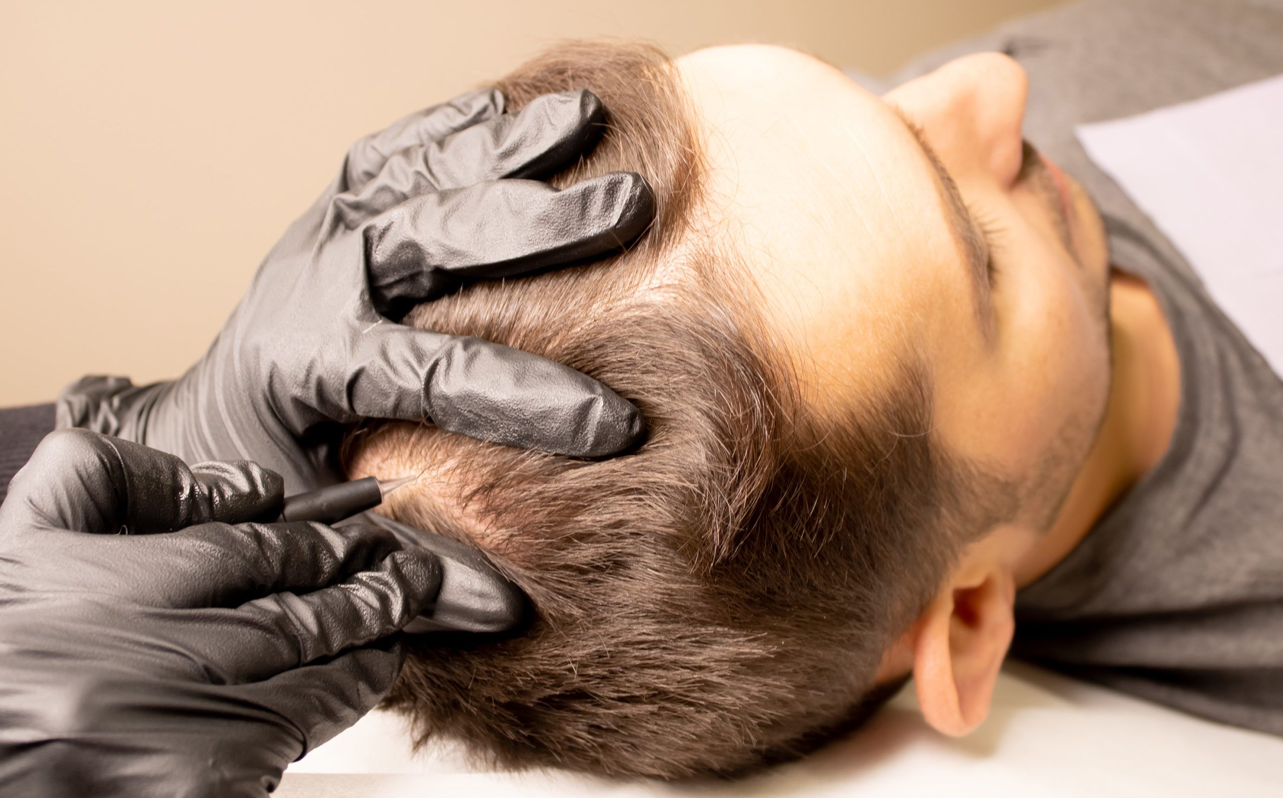 Male trichopigmentation service. Young man laying on the back on the esthetician table. Master hands in a black gloves holding the permanent makeup machine with the needle and touching mans hair.