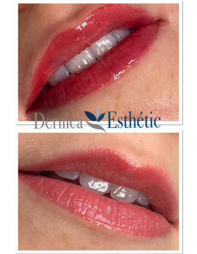 Lèvres après dermopigmentation